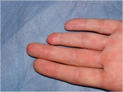 Extension of the finger after a traumatic tip amputation - after 6 months